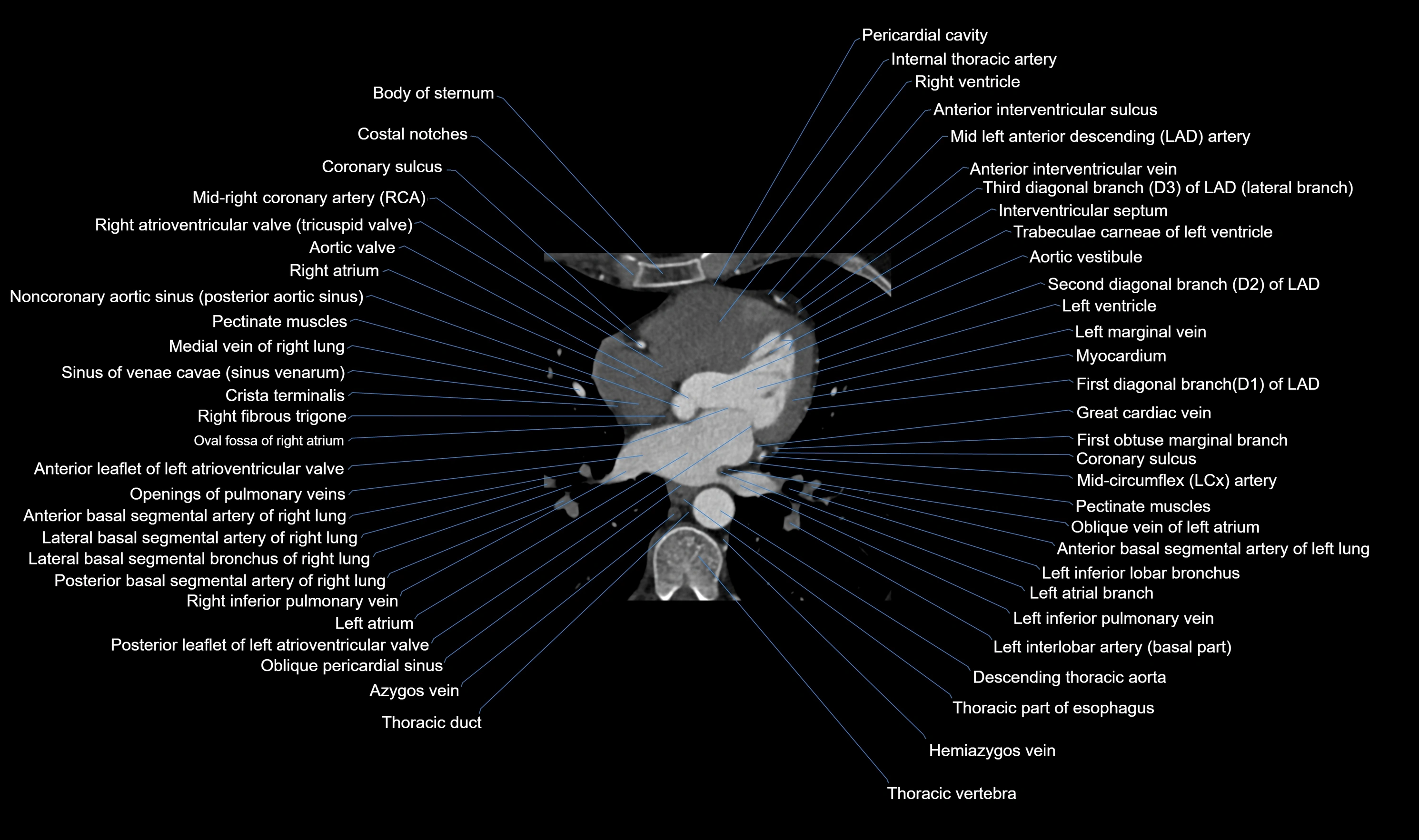 CT heart (coronary angiogram) axial view cross sectional anatomy labelled radiology image-00034.webp